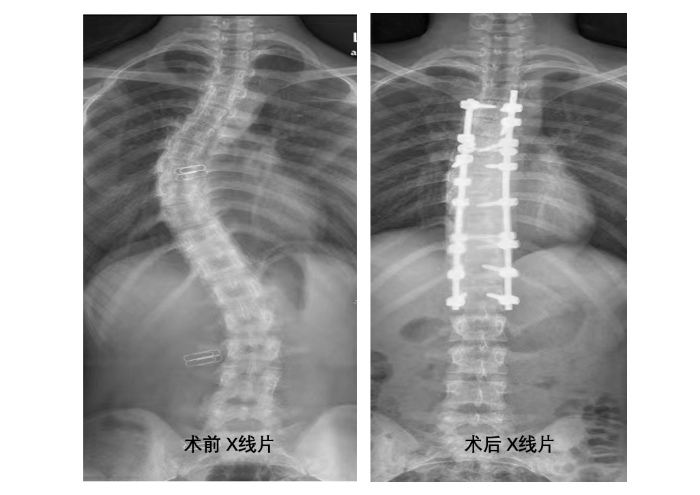 術(shù)前、術(shù)后x線片